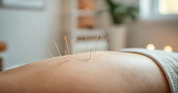 Benefícios Comprovados da Acupuntura para Saúde e Bem-Estar Duradouros