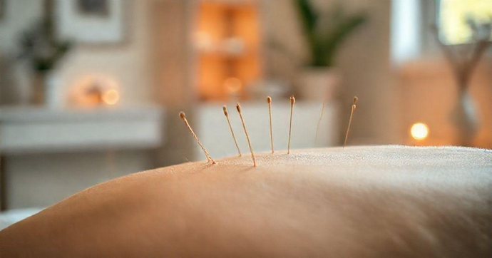 Benefícios da Acupuntura para Saúde e Bem-Estar