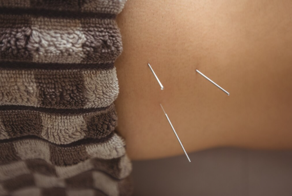 Acupuntura: Benefícios Essenciais para o Bem-Estar e Saúde Natural