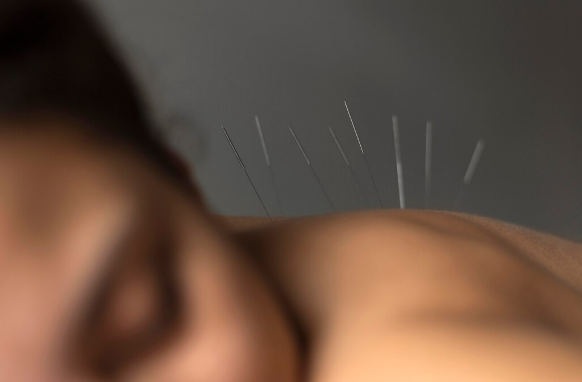 Acupuntura: Benefícios para Bem-Estar e Saúde Integrativa