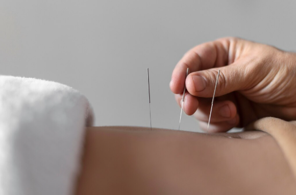 Acupuntura: Benefícios Transformadores para Sua Saúde e Bem-Estar