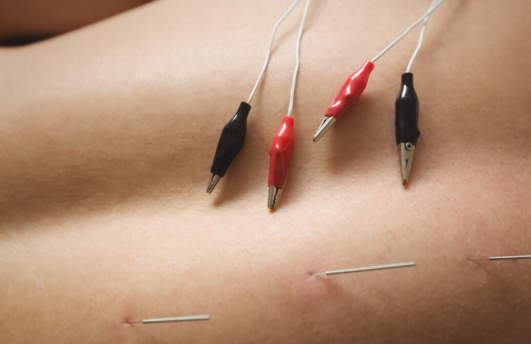 Acupuntura em Santo André: Bem-Estar e Saúde Natural