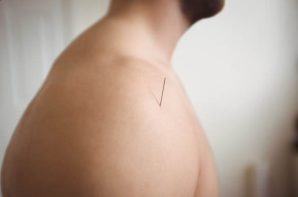 Acupuntura em Santo André: Benefícios para Bem-Estar e Saúde Holística