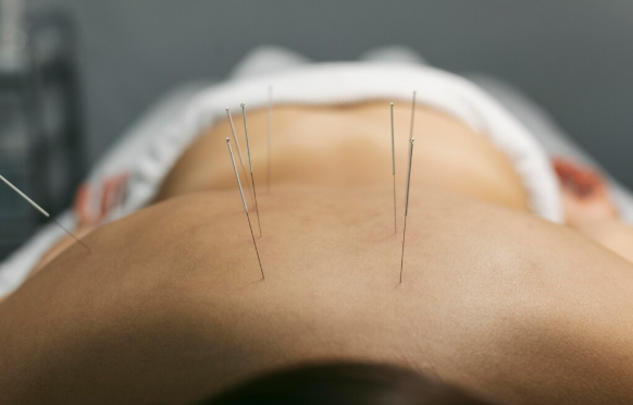 Acupuntura em Santo André: Benefícios para Saúde e Bem-Estar