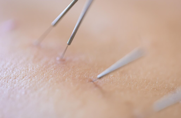 Acupuntura para Bem-Estar: Benefícios em Santo André