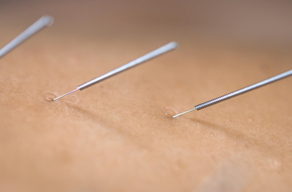 Acupuntura e Seu Impacto Positivo no Bem-Estar Diário