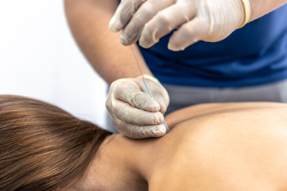 Acupuntura em Santo André: Como Melhorar Seu Bem-Estar e Saúde Natural