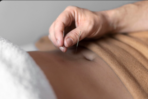 Acupuntura em São Paulo: Principais Benefícios para Sua Saúde