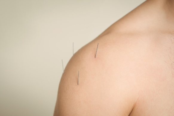 Benefícios da Acupuntura em Santo André para Equilíbrio Energético e Bem-Estar