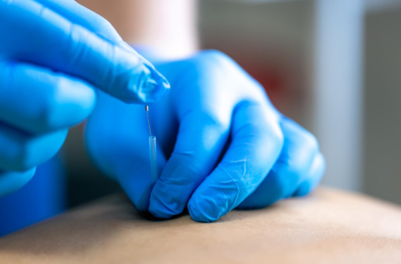 Benefícios da Acupuntura em São Paulo: Transforme Sua Saúde com Essa Técnica Terapêutica