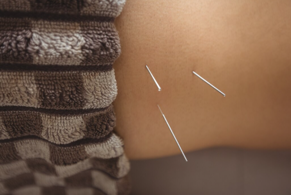 Benefícios da Acupuntura para Promover Seu Bem-Estar e Saúde Natural