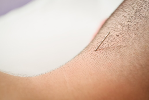 Benefícios e Técnicas de Acupuntura em Santo André para Potencializar Seu Bem-Estar