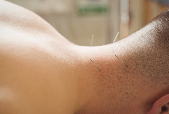 Como a Acupuntura em Santo André Pode Melhorar Sua Saúde e Bem-Estar