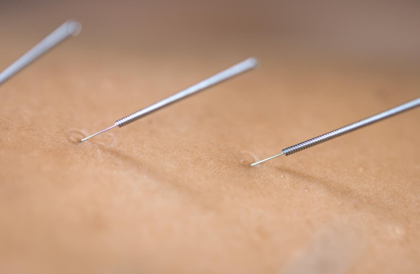 Conheça os Principais Benefícios da Acupuntura para Saúde e Qualidade de Vida