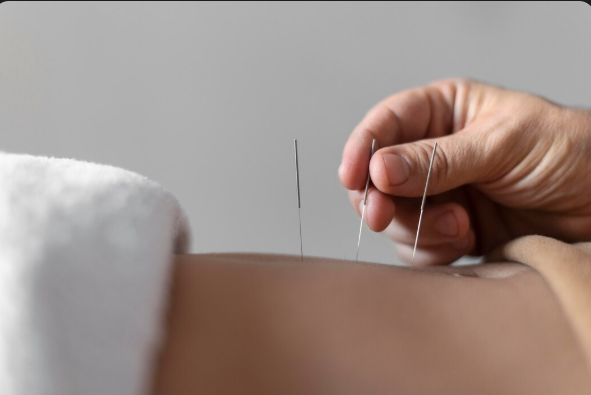 Principais Benefícios da Acupuntura para Saúde Integral e Bem-Estar