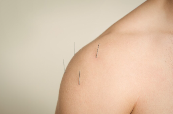 Vantagens da Acupuntura em Santo André para Melhorar Seu Bem-Estar